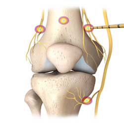 Radio Frequency Ablation